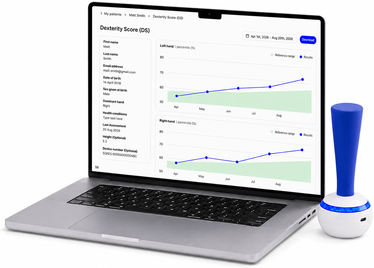 A laptop showing a child's Dexterity Score page, with left and right hand percentile charts against a reference range, next to a SqueezAble device